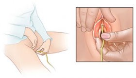sonda urinara la barbati prostatita ceftazidimă