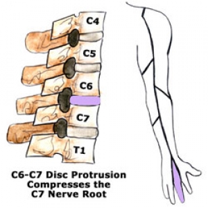 Leziune a coloanei in zona vertebrei C6