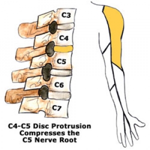 Leziune a coloanei in zona vertebrei C4