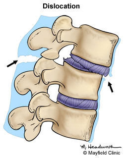 Intr-o dislocare, ligamentele sunt intinse sau rupte, permitand vertebrei sa ieasa din aliniere