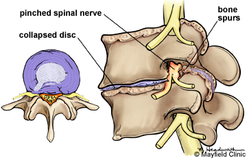tratamentul discului spinal