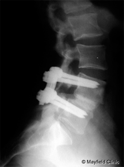 Razele X arata  suruburile, tijele si grefele osoase ce au fost plasate pentru a realinia vertebrele una peste cealalta si a crea fuziunea spinarii