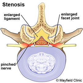 stenoza lombara