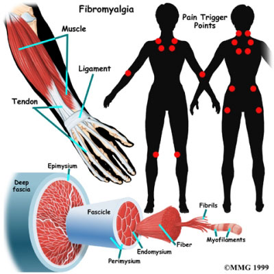 fibromialgia durerii musculare și articulare