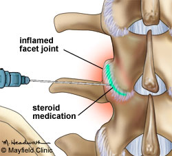 Injecții pentru blocarea durerilor articulare - Tulburări ale articulațiilor temporomandibulare