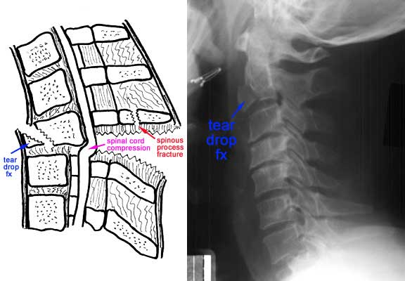 leziune articulară vertebrală