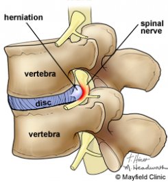 hernie de disc intre vertebra L5 si sacrum