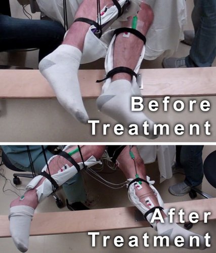 Abordarea non-chirurgicala ajuta persoanele care sufera de paralizie sa mearga isi deplaseze picioarele in mod voluntar