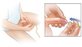 usturimi pe canalul urinar la barbati reteta de sifon pentru prostatita