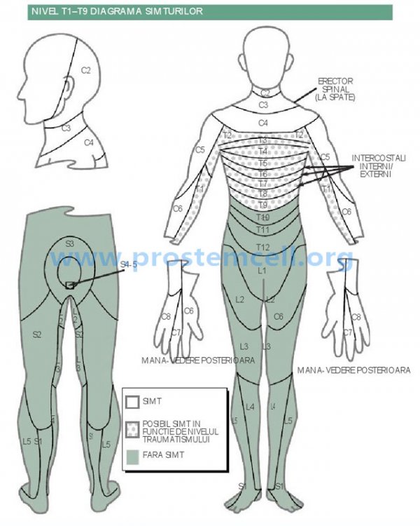 Functionalitatea leziunii coloanei vertebrale in zona vertebrelor T1 - T9