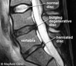 Imaginea RMN arata o hernie de disc