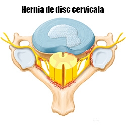 Hernia de disc cervicala