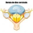 Cum se manifesta hernia de disc cervicala ?