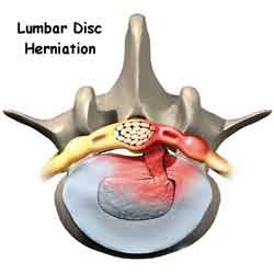 Hernia de disc lombara