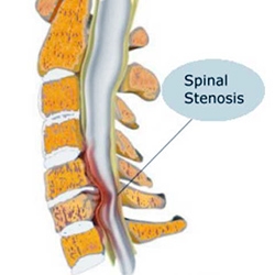 Stenoza spinala