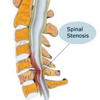 tratament spinal și articular exacerbarea medicamentelor pentru osteochondroză