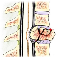 Disfunctia articulatiei sacroiliace, cauza a durerii lombare