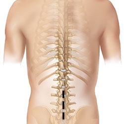 Decompresia coloanei vertebrale (laminectomie)