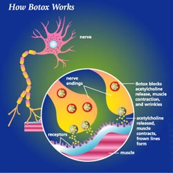 Efectele botoxului asupra motoneuronilor