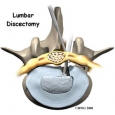 Disectomia lombara posterioara