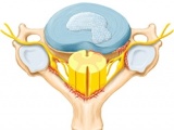 Hernia de disc cervicala
